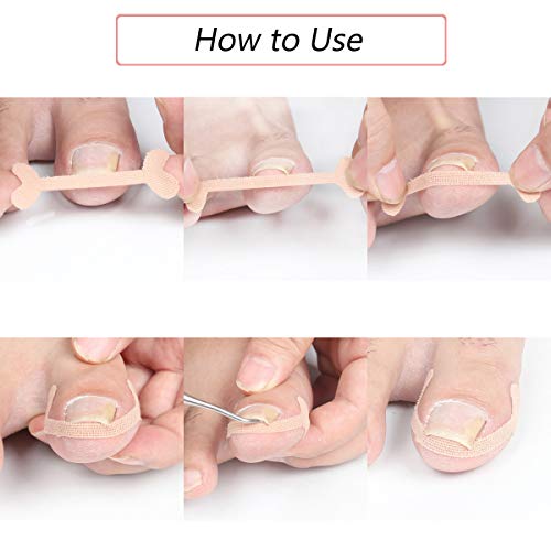EBANKU 5 listova/20 kom naljepnice za korektor uraslih noktiju, tretman nožnih noktiju elastični flaster naljepnica korektor pedikir alati za nokat njega nožnih noktiju štiti nožni nokat