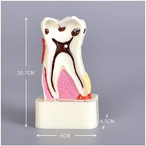 KH66ZKY 4 puta zubni karijes Model sveobuhvatni patologijski model zuba Karijes Kalusice kalkulus