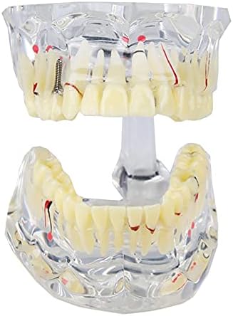 KH66ZKY Zubni implantat nervni karijes prikaz modela prozirne odrasle patologije Stomatološki model koji nedostaje zub za stomatologe studenti koje podučavaju učenje zaliha